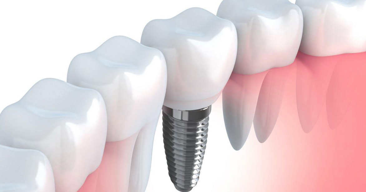 Что такое имплант зуба и как его поставить
