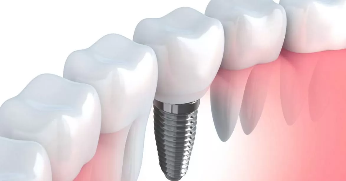 Що таке імплант зуба і як його поставити Фото 2