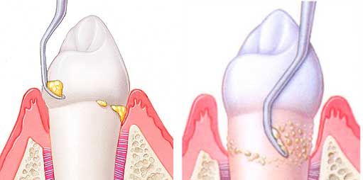 Как удалить зубной камень эффективно и безопасно