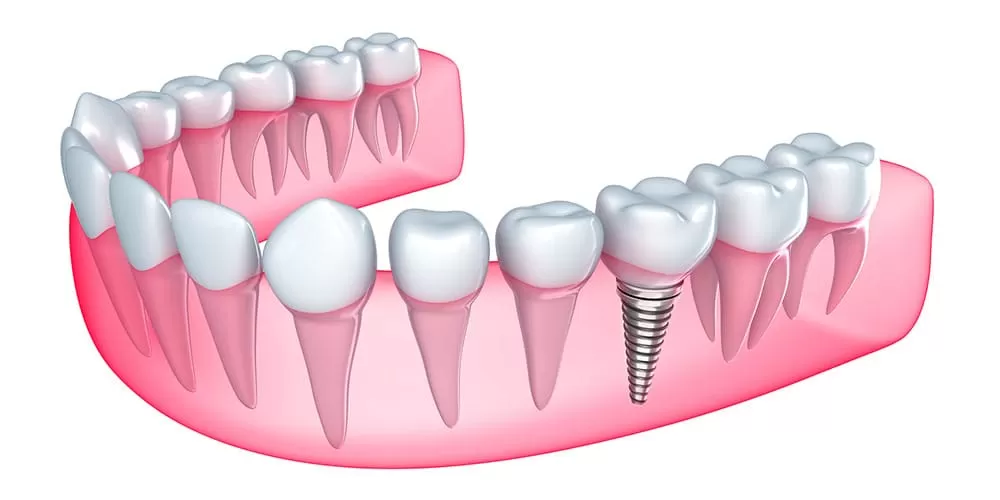 Prosthetic Implants Фото 4