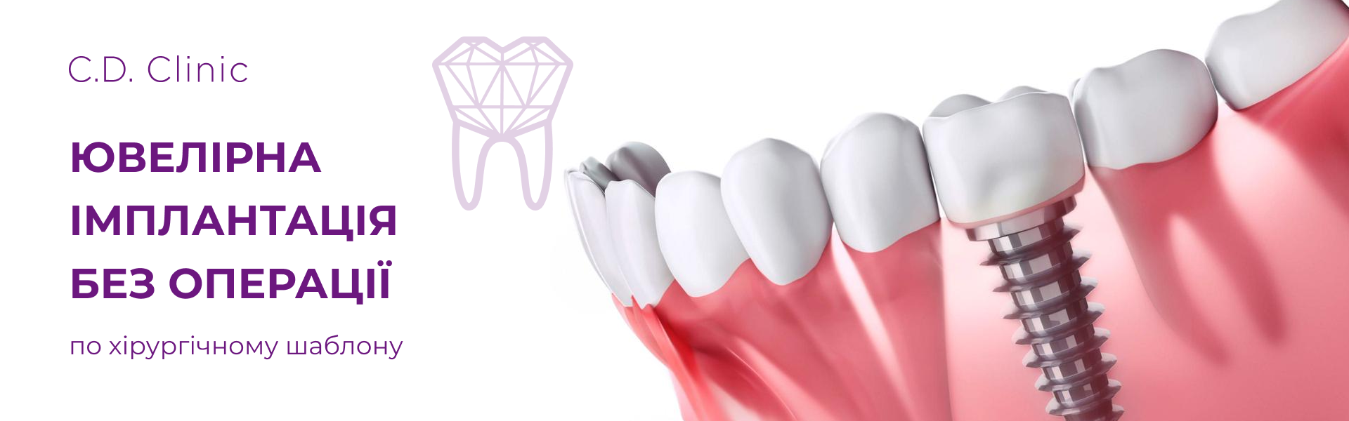 Ювелірна імплантація зубів